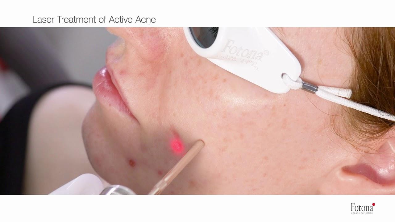 acne active laser image