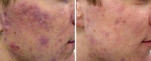 acne revision image