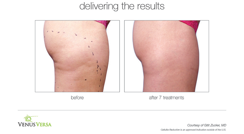 cellulite reduction comparison image