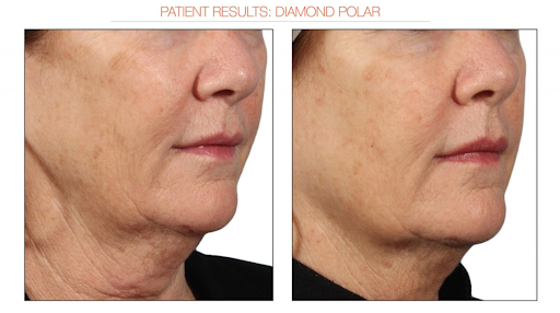 skin resurfacting image