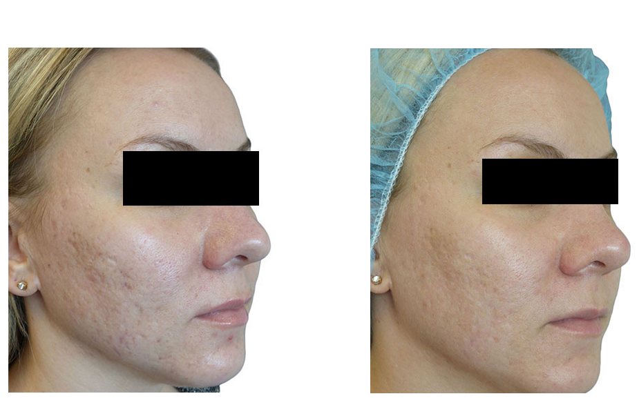 skin resurfacting image