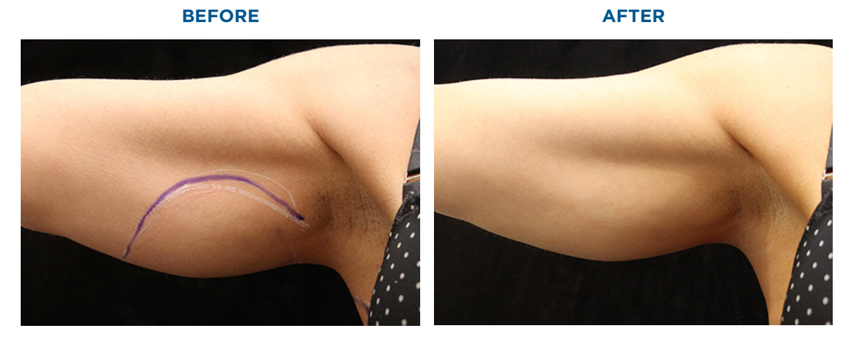 btl exilis comparison image two