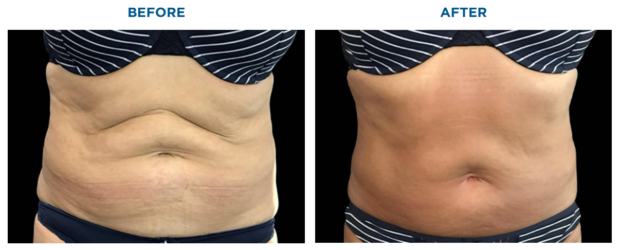 btl exilis comparison image