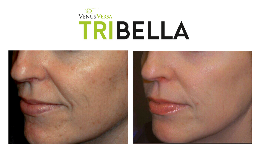 ultra glow tribella image