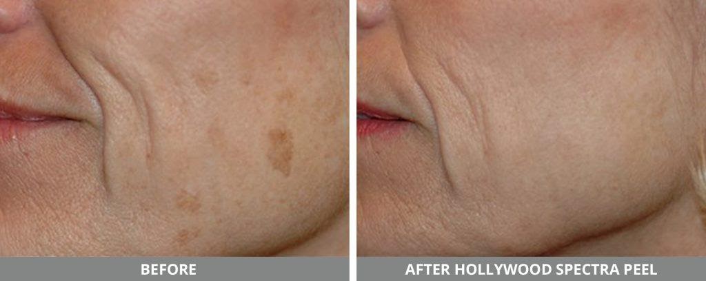 Laser Hollywood Peel image