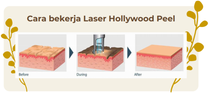 Laser Hollywood Peel image