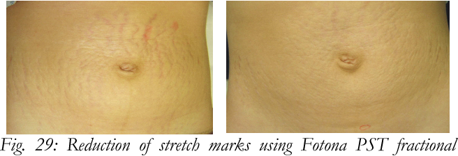 Laser Stretchmark image