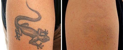 Fotona Laser Tattoo Removal process