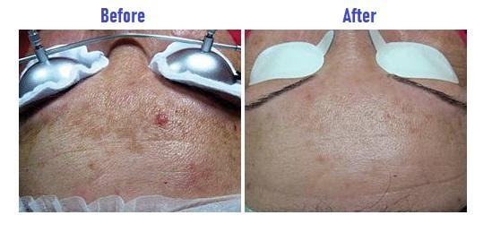 Laser Toning Melasma comparison