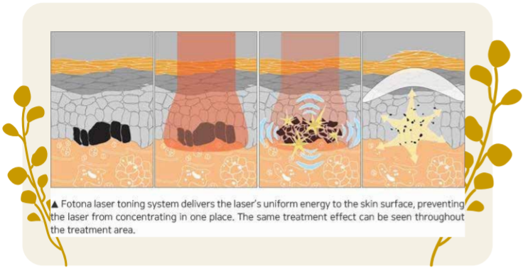 Laser Toning Melasma info graphics